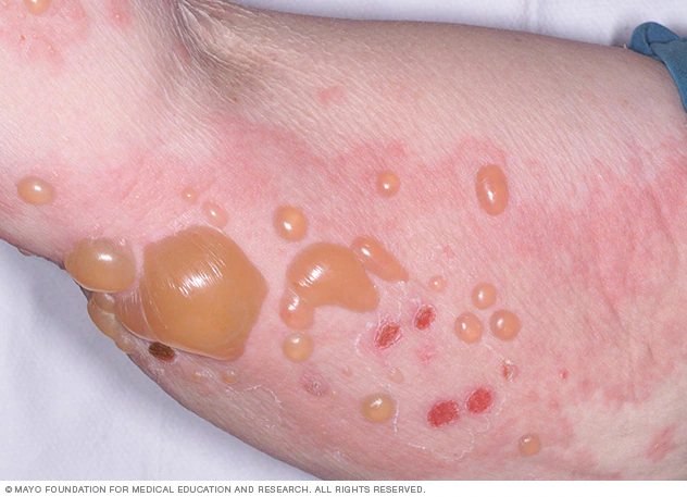 Syphilis on the side of penis
