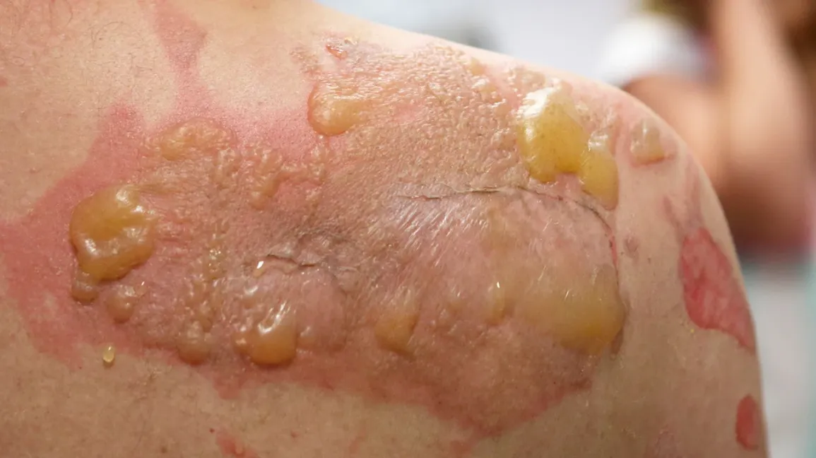 Syphilis on the side of penis