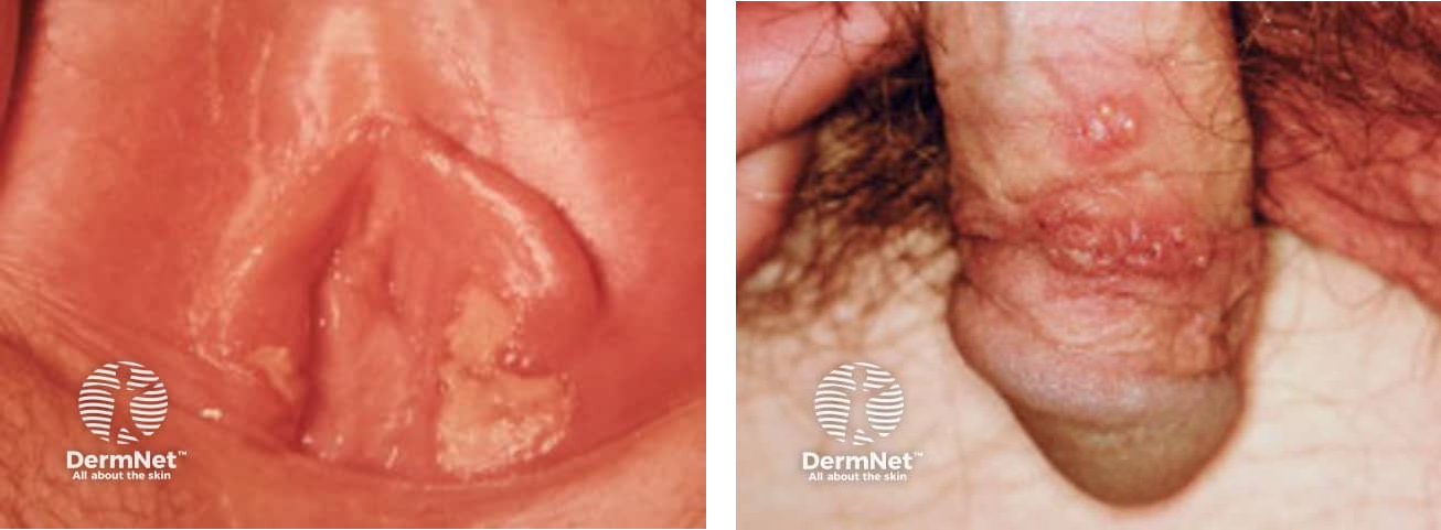 Genital Herpes