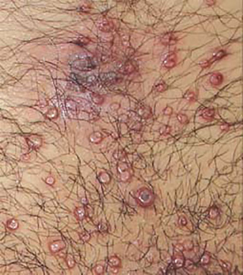 Genital Molluscum Contagiosum
