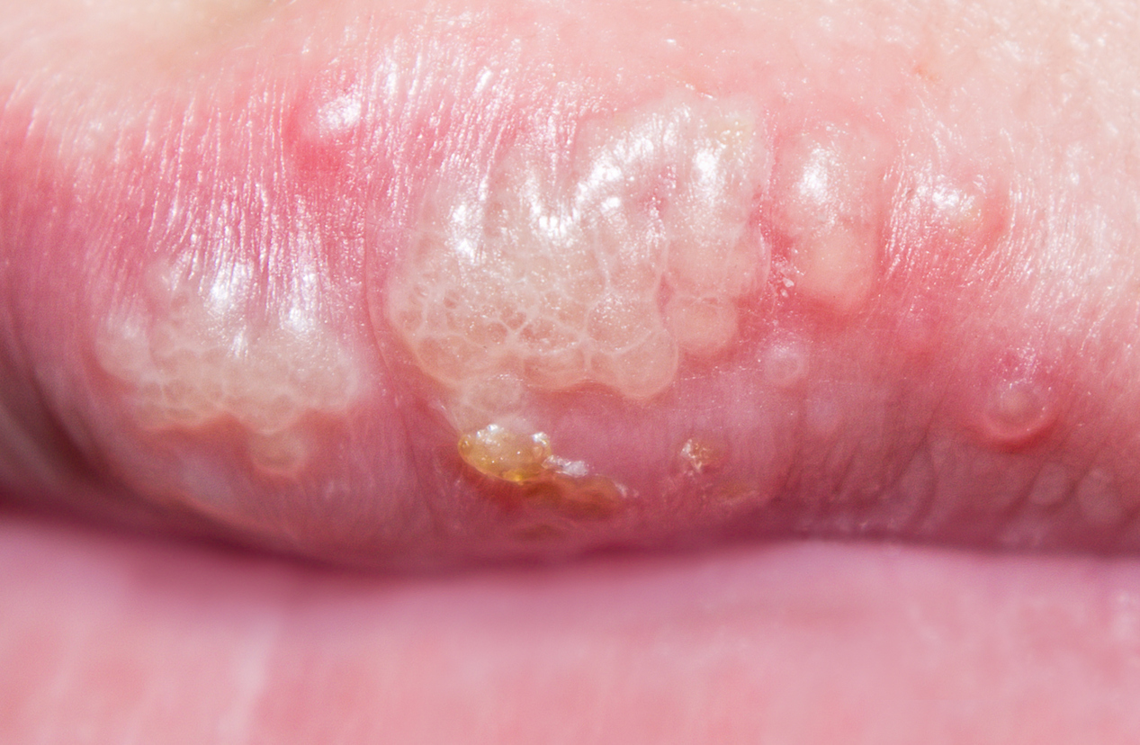 Herpes on Lip
